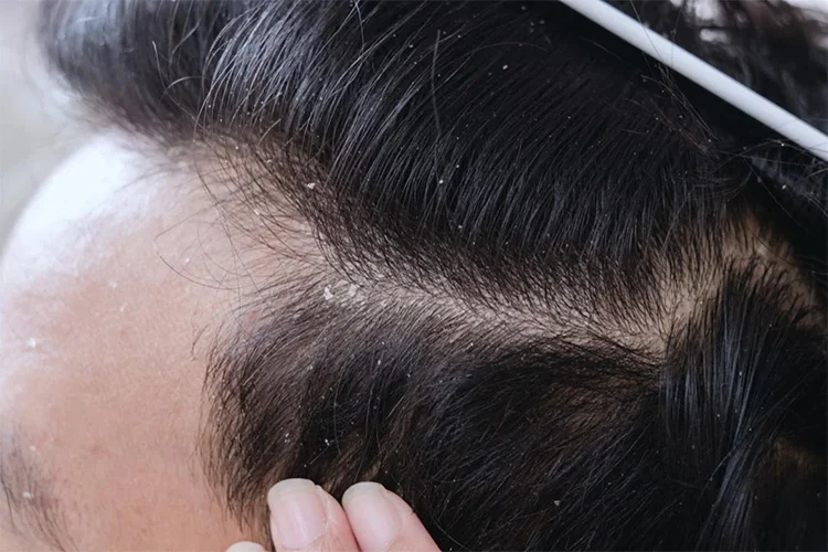 Vì sao nam giới dễ gặp tình trạng về gàu?